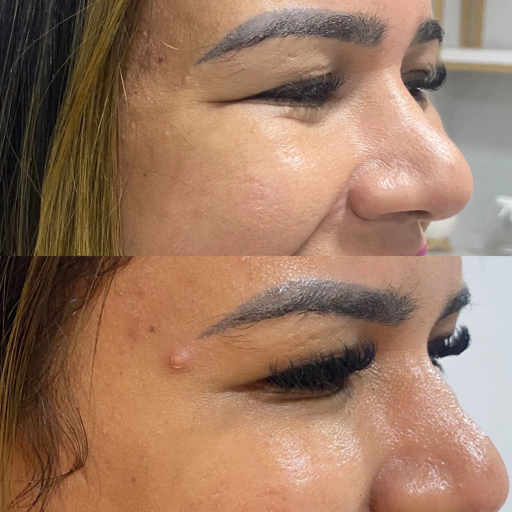 Resultado de Botox - 23/04/2026