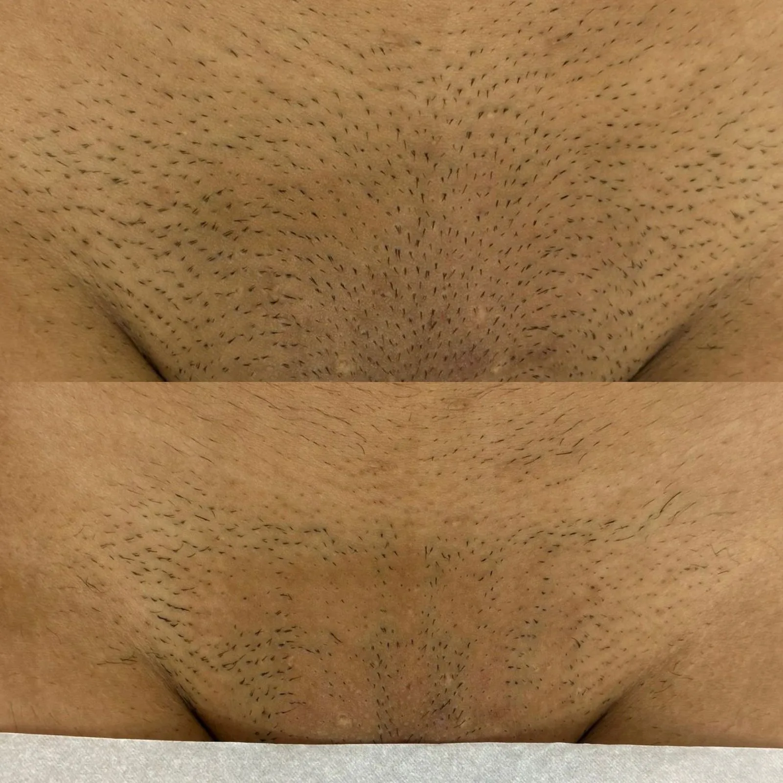 Resultado de Depilação a Laser - 24/04/2026