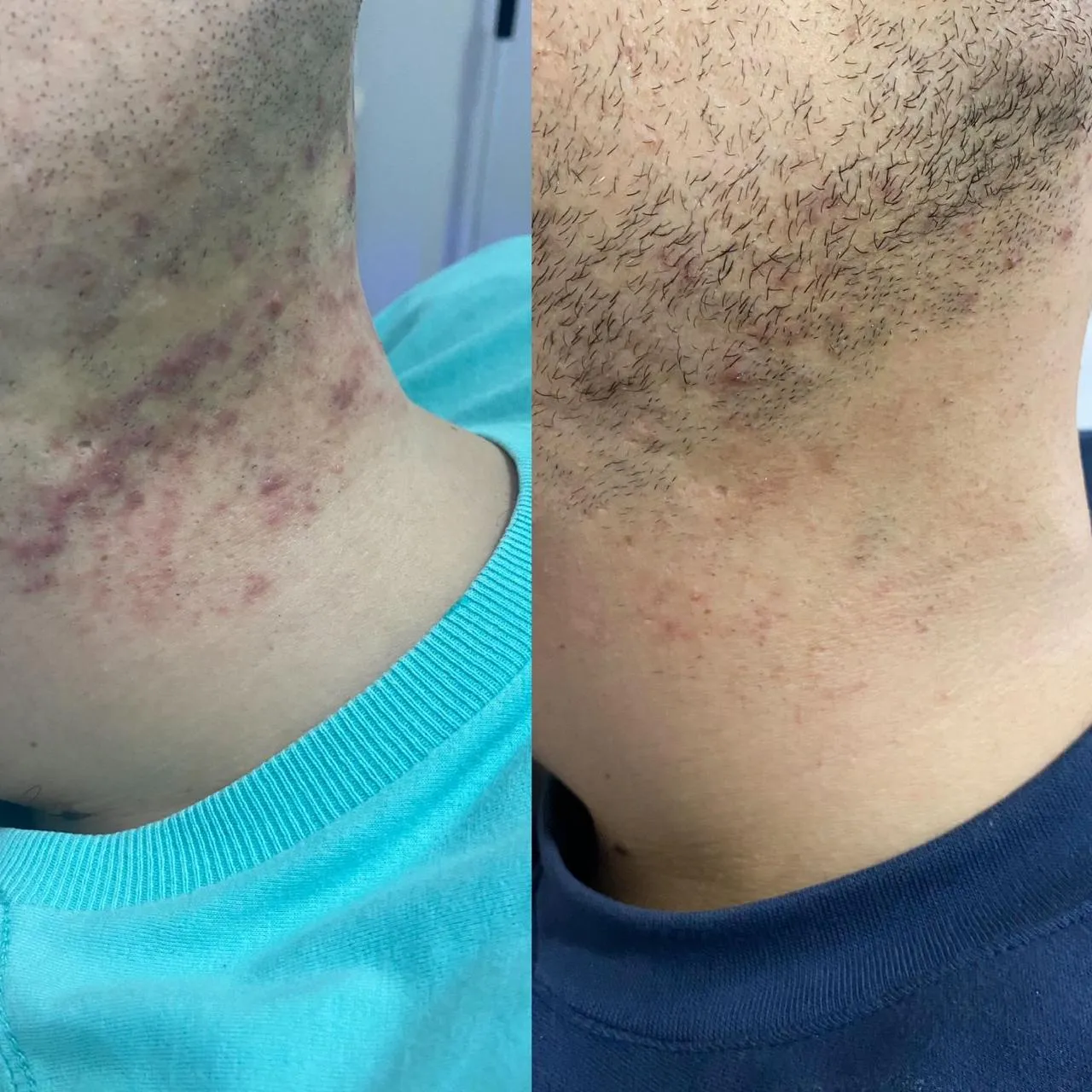 Resultado de Depilação a Laser - 24/04/2026