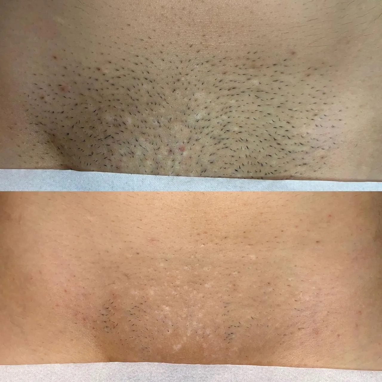 Resultado de Depilação a Laser - 24/04/2026