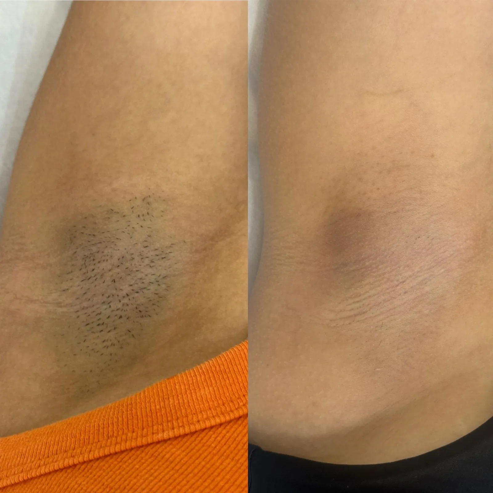 Resultado de Depilação a Laser - 24/04/2026