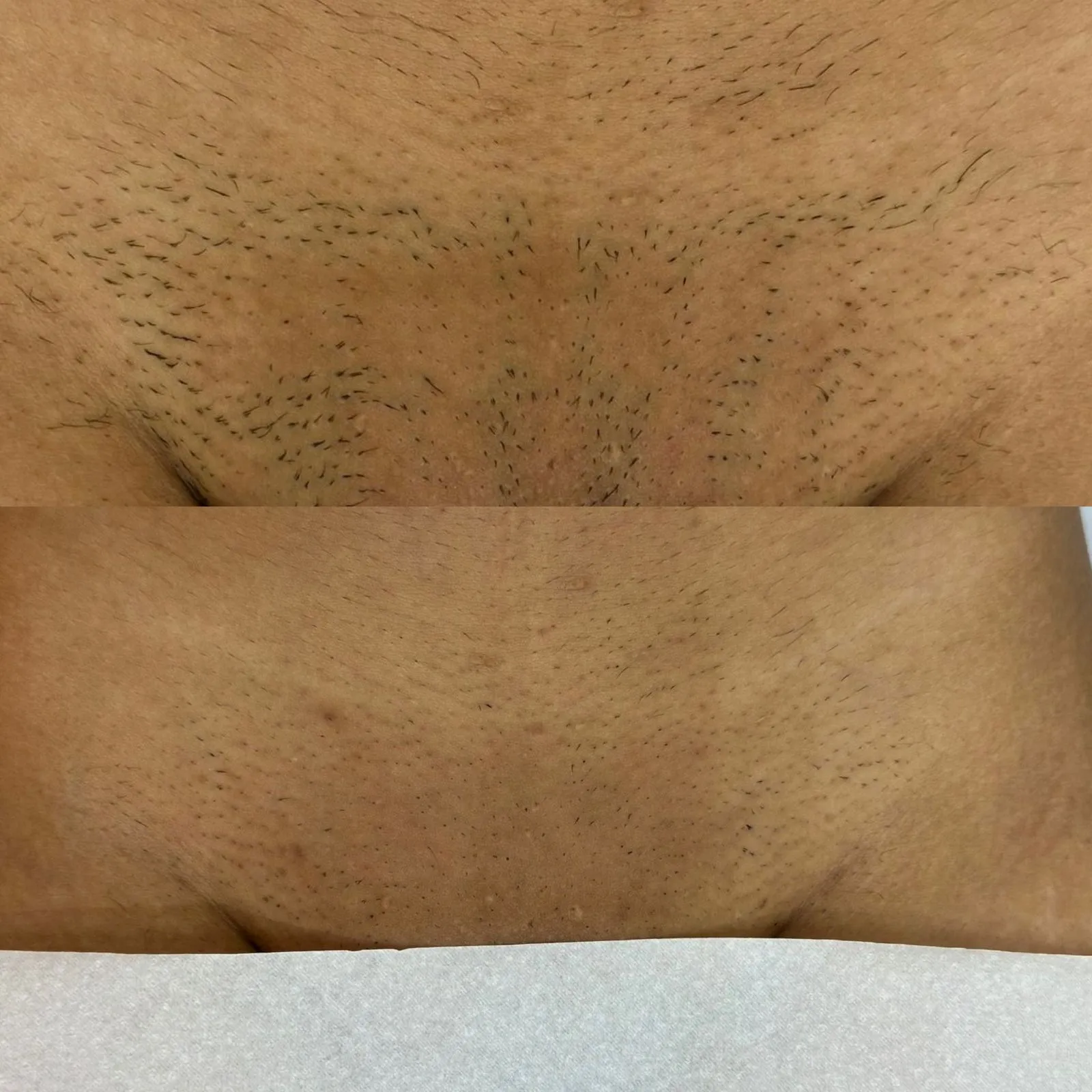 Resultado de Depilação a Laser - 24/04/2026