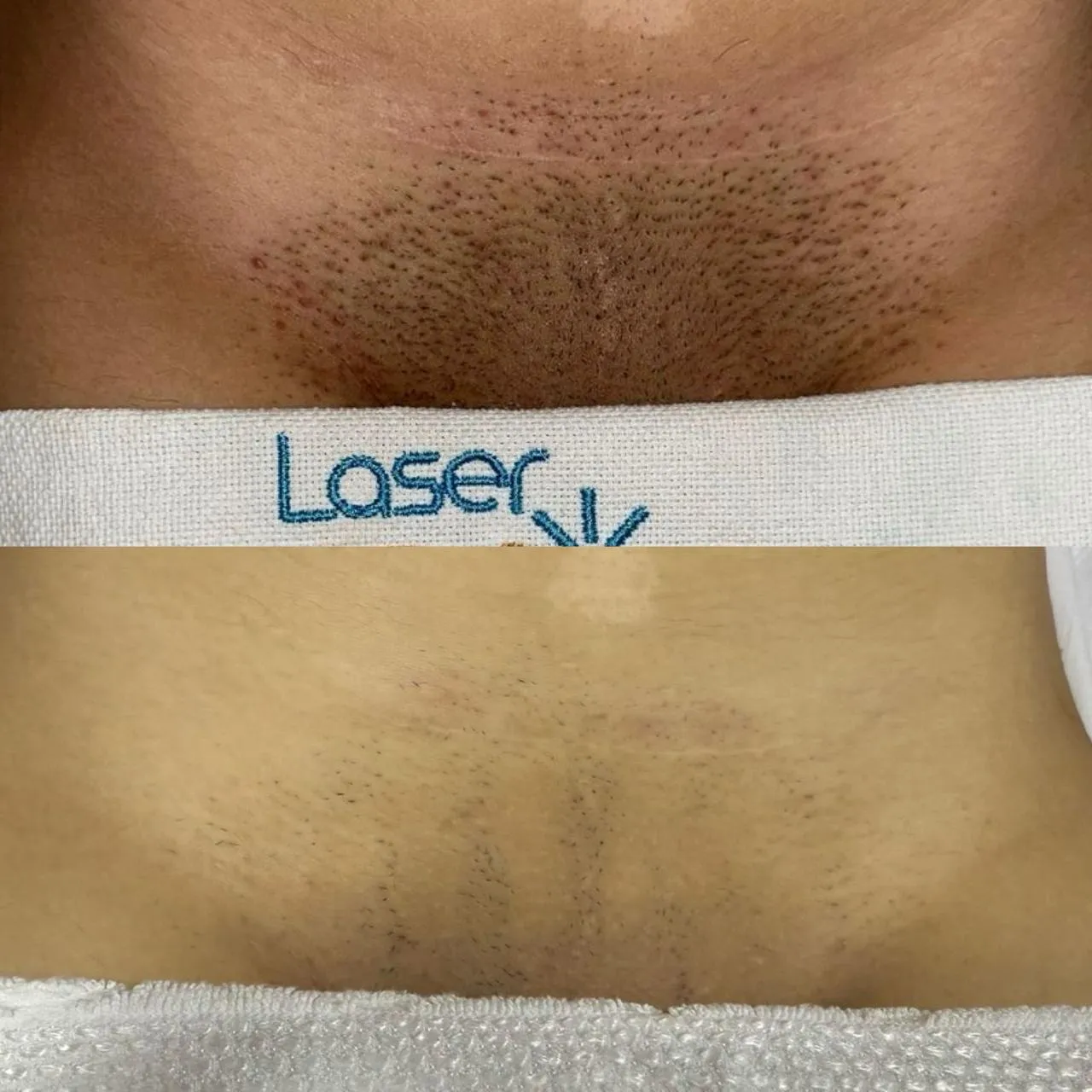 Resultado de Depilação a Laser - 24/04/2026