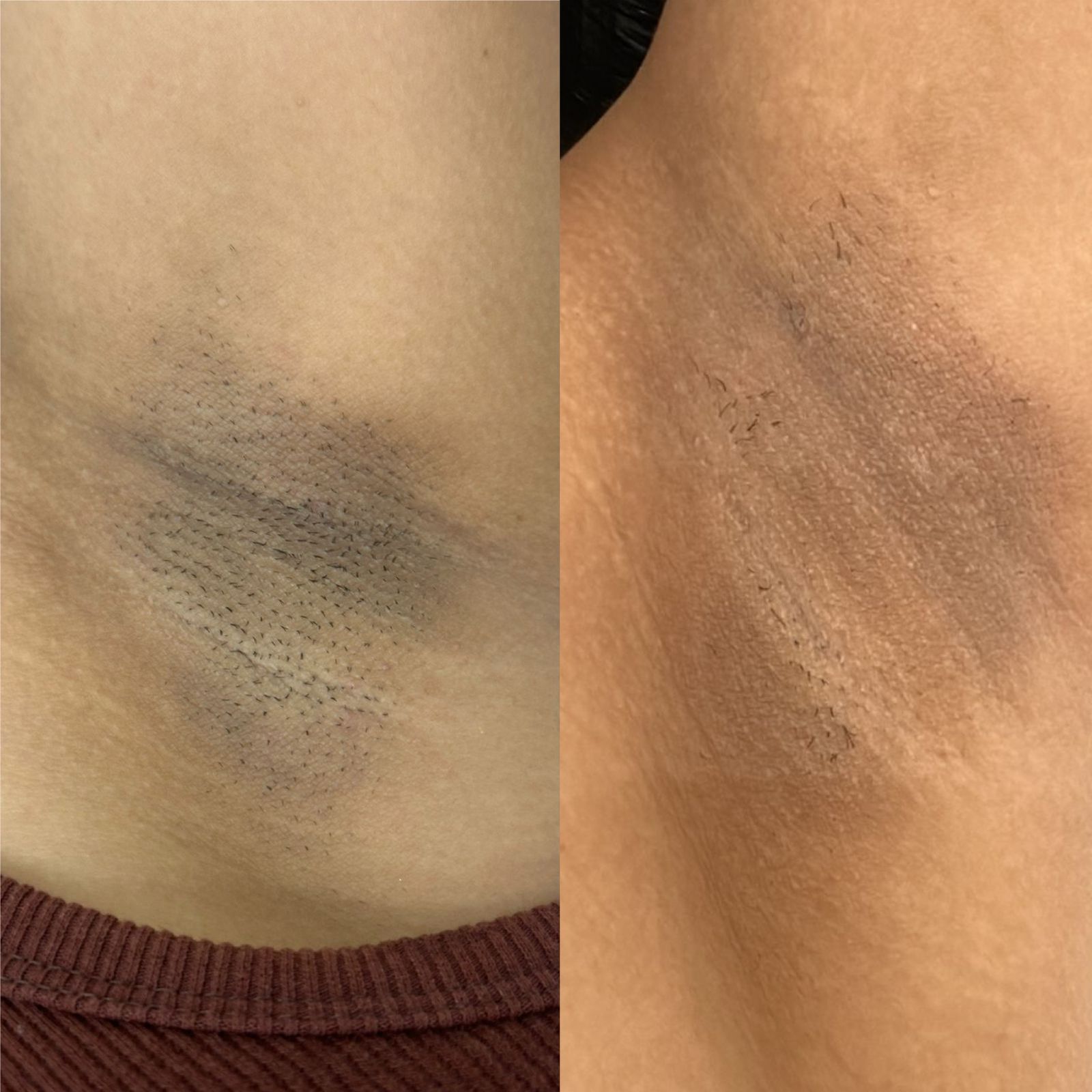 Resultado Real Depilação a Laser Axilas