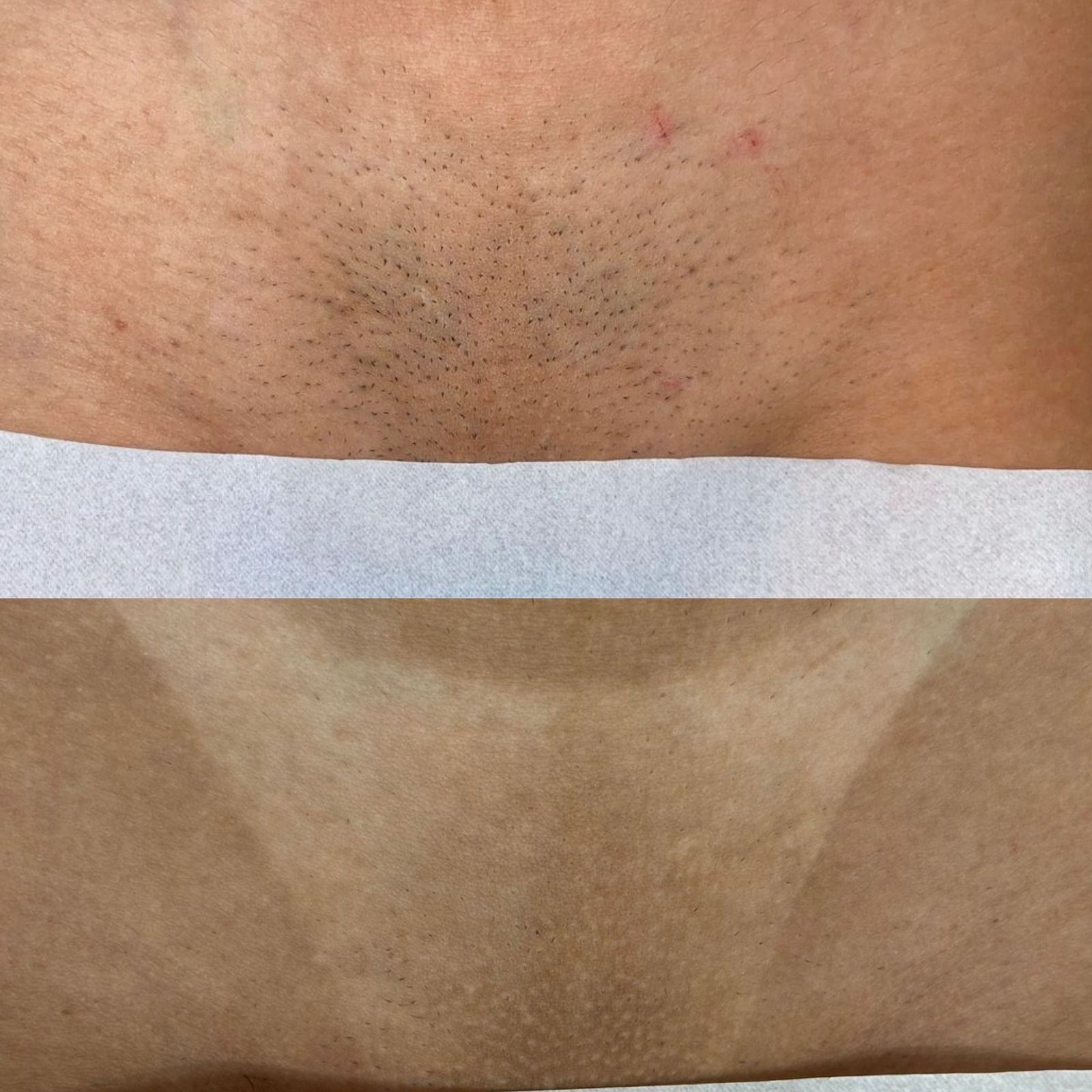 Resultado Real Depilação a Laser Virilha